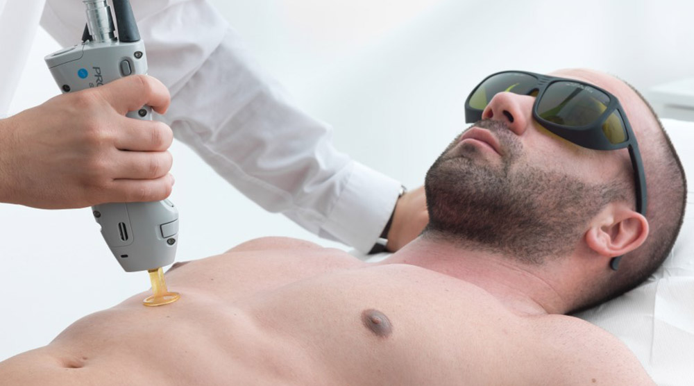 Laser Hair Removal for Men - CHIC Med-Aesthetic Clinics